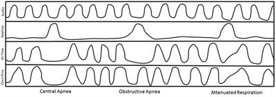 Swallow–Breath Interaction and Phase of Respiration with Swallow during Non-Nutritive Suck in Infants Affected by Neonatal Abstinence Syndrome